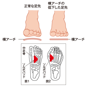 ソルボ ヨコアーチサポーター 薄型 各サイズ｜からだはうす｜スポーツ